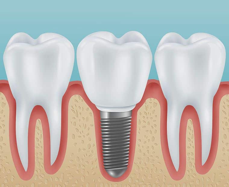 Dental Prosthetics With Healthy Teeth