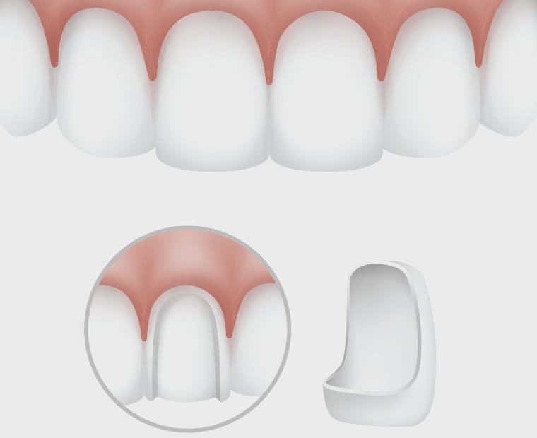 Dental Veneers