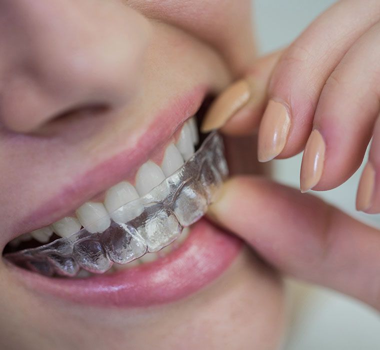 woman wearing orthodontic invisible braces