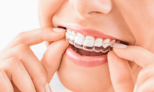 Clear Aligners